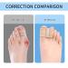 2 Pairs Gel Bunion Spacers & Toe Protectors | Relief for Hammer Toes & Hallux Valgus | Foot Pain Relief for Men & Women - Buy Online on GoSupps.com