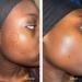 AWARD-WINNING Acne Cream - 4X STRONGER 11X FASTER! Patented technology features Organic Salicylic Acid. Target Blackheads & Blemishes - 100ml - Buy Online on GoSupps.com