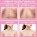 Body Acne Clearing Treatment Serum | Salicylic Acid & Tea Tree Oil | Clear Acne on Buttocks Thighs Back & Chest | 1.37 fl oz - Buy Online on GoSupps.com