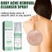 Acne Treatment Spary Back Acne Treatment Serum Body Moisturiser For Acne Body Moisturiser For Dry Skin Acne Moisturiser Reduce Back Acne & Body Acne Smoothing Moisturiser For Acne Prone Skin-120ml - Buy Online on GoSupps.com