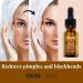 SKIN LABO SkinLabo Active Serum Aha + Bha Eliminates Surface Dead Cells Skin Perfecter with Exfoliating and Purifying Action 15 ml (Old Version) - Buy Online on GoSupps.com