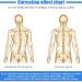 Spinal Back Orthosis Adjustable Scoliosis Corrector with Soft Shoulder Pads 3-point Mechanics Principle Structure and Relieve Pressure Adjustable 4 Levels Heighta and Position for Hunchback - Buy Online on GoSupps.com