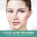 Cystic Acne Treatment: Effective Hormonal Acne Cream for Face | Acne Treatment - Buy Online on GoSupps.com