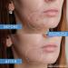 Curist Adapalene 0.1% Acne Free Gel 90-Day Supply - 45g XL Tube - Topical Retinoid Acne Medicine - Clear Whiteheads, Blackheads & Pores - Face Treatment - Buy Online on GoSupps.com