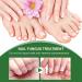 Fungal Nail Treatment - Extra Strong Nail Fungus Treatment for Toenail and Fingernail - Anti fungus Nail Repair and Strengthen Fix & Renew Damaged Broken Nails 1PC - Buy Online on GoSupps.com