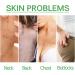 Trendyfave Dark Spot Correcting Glow Serum Skin Tag Removal Age Spot Remover For Face Scar Treatment Pore Minimizer Serums Skincare Contains Tea Tree Oil Vitamin E Body Acne Treatment 30ml - Buy Online on GoSupps.com