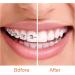 MIBICIRI 12Pcs Aligner Chewies for Trays Aligner Chewies for Invisible Braces Aligners for Orthodontic (Orange) - Buy Online on GoSupps.com