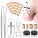 Ingrown Toenail Treatment  Professional Ingrown Toenail Removal Kit Includes Ingrown Toenail Corrector  Tweezer  10pcs Corrector Strips  12pcs Podiatry Toenail Braces and 50pcs Toenail Corrector Patch