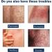 TGMALL 2023 Psoriasis Treatment Spray & Soothing Ointment - Skin Cleansing Relief (3pcs) - Buy Online on GoSupps.com