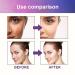 144Pcs Acne Stickers for Home, Irregular Shape Pimple Elimination - Acne Patches - Buy Online on GoSupps.com