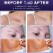 Silicone Scar Gel for Surgical Scars, Stretch Marks, Acne & Keloids - Scar Removal Cream Gel for New Scars - Buy Online on GoSupps.com