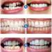 Lifi 4 Paires de Proth ses Dentaires Cosm tiques | Facettes Dentaire Dentier Temporaire & Blanchiment des Dents - Am liorez Votre Sourire ! - Buy Online on GoSupps.com