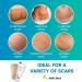 AWD Silicone Scar Sheets for Effective Scar Removal | Surgical C Section Keloid Tummy Tuck Tape - 5 Pcs 1.6 x 6 Nude - Must-Have Skin Patches - Buy Online on GoSupps.com