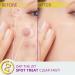 Azelaic Acid 12% Azelaic Acid For Face Serum Rich in Niacinamide and Hyaluronic Acid Fades Post Acne Marks and Calms Redness Formula for Uneven and Blemish Prone Skin Care Unflavored - Buy Online on GoSupps.com