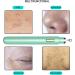 Visible Blackhead Remover with Camera Advanced Pimple Popper with Camera Acne Comedone Whitehead Extractor Kit Skin Care Pore Clean Tool - Buy Online on GoSupps.com