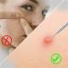 HudiMsat Blackhead Remover Pimple Comedone Extractor Tool Acne Removal Kit Zit Removing for Risk Free Nose Face Skin with Case 4PCS silvery - Buy Online on GoSupps.com