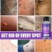 Skin Tag Removal Solution.(2PC 30ML) 2PC 30ml - Buy Online on GoSupps.com