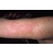 Caladryl Lotion - Soothing Relief for Burns, Bug Bites, and Skin Irritants - Buy Online on GoSupps.com