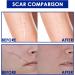 HEXILIN Gentle Scar Removal Cream for All Skin Types - Skin Repair and Diminish Scars, One Size - Buy Online on GoSupps.com
