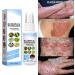 DUBUSH Melllop Herbal Psoriasis Soothing Mist - Skin Rejuvenating Psoriasis Treatment - 3pcs - Buy Online on GoSupps.com