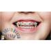 Artman Braces Color Bands - 1040 PCS Multicolored Orthodontic Ligature Ties for Easy Change - Buy Online on GoSupps.com