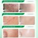 Salicylic Acid Acne Cream 50g - 3% BHA Spot Cream for Acne - Blackhead Remover - Dark Spot Remover for Face - Scar Removal Cream - Moisturizing Face Cream for Women - Pimple Cream for Redness - Buy Online on GoSupps.com