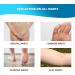 Uforic Health Wart Remover - Maximum Strength Treatment for Genital & Plantar Warts - Men & Women (1-Pack) - Buy Online on GoSupps.com
