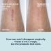 Trasta Medica Silicone Scar Sheets - 4 Pcs Surgical & Old Scars Tape - Natural Silicone Gel for Skin Friendly Treatment - Acne, C-Section & Burns - Buy Online on GoSupps.com