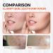 Dark Spot Corrector with 10% Azelaic Acid & Niacinamide | Acne & Rosacea Treatment | Pore Refining & Redness Relief - Buy Online on GoSupps.com