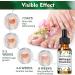 Fungal Nail Treatment 30ML - Extra Strong Solution for Toenails & Fingernails - Restores Healthy Nails - Protects Thick, Broken, and Discolored Nails - Green-1 - Buy Online on GoSupps.com