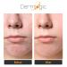 Dermlogic Acne Treatment Pads with Glycolic, Lactic, Salicylic Acid for Oily Skin, Clogged Pores, and Breakouts - Removes Dark Spots and Pimples on Face & Body - Buy Online on GoSupps.com