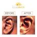 Keloid Removal Duo - Effective Treatment for Keloids | Fast International Shipping - Buy Online on GoSupps.com