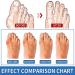 OBODN 6 Pcs Orthopedic Bunion Corrector Splint Toe Separator & Pain Relief - Buy Online on GoSupps.com
