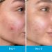 LitBear Pimple Patches | Invisible Hydrocolloid Acne Treatment | 66 Assorted Salicylic Acid Spot Covers for Whiteheads & Cystic Acne - Buy Online on GoSupps.com