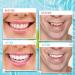Nuanchu False Teeth Veneers Set - Temporary Dentures for Men & Women | White Dental Repair for Broken Teeth - Fits Most Sizes - Buy Online on GoSupps.com