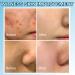 Acne Repair Face Cream - Moisturiser Face Women - Face Moisturizer for Women - Deeply Nourishes Skin - Skin Lightening Cream - Light Texture and Easy Absorption - Buy Online on GoSupps.com
