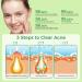 Cystic Acne Spot Treatment | Hormonal Acne Cream for Teens & Adults | Aloe Vera Tea Tree Oil & Witch Hazel Pimple Treatment - Buy Online on GoSupps.com