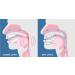 Snorflex Snoring Stopper | Premium Two-Part Anti-Snoring Splint with Elastic Straps & Quick Adjustment - International Shipping Available - Buy Online on GoSupps.com