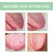 Fissured Tongue Relief Spray 2pcs Fissured Tongue Relief Spray 8ml Remove Odor Regulates Oral Health Breath Fresheners Oral Fissured Tongue Spray Fissured Tongue Sprayer - Buy Online on GoSupps.com