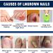 Nail Repair Patches Toenail Patches Ingrown Toenail Treatment Broken Nail Repair Toenail Stickers Toenail Corrector Patch Toe Nail Correct Stickers Comfortable Correction Patch Stickers For Toenail - Buy Online on GoSupps.com