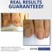 ClearNail Pro+ Extra Strength Toenail Fungus Remover - Restore Discolored Thickened Nails - Ideal Post Laser Treatment - Buy Online on GoSupps.com