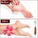 Callus Shaver Foot Care Kit - Includes Callus Remover, Foot File, 10 Blades, and Storage Cover (15Pcs) - Buy Online on GoSupps.com