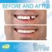 Instant Smile Thermal Fitting Temporary Tooth Replacement Beads - Buy Online on GoSupps.com