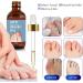 Ingrown Toenail Treatment 30ml Ingrowing Toenail Treatment Toenail Anti Paronychia Relief Oil Correction Ingrown Toenail Softening Drops for Damaged Discolored Thick Nail - Buy Online on GoSupps.com