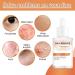 2024 New 1/2/3/4Pcs Milia Clearing Essence - Milia emover Eye Serum | Milia emover Milia Spot reatment | Miliary epair Essence | Moisturize Skin | Improve Skin Texture for All Skin Types - 30ml/1fl.oz (1pcs Milia Remover Serum) - Buy Online on GoSupps.com