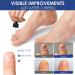 3 Pcs German Paronychia Oil for Toenail Care | Repair & Improve Toenail Health - Buy Online on GoSupps.com
