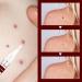 Anti Wart - Anti Wart Pen - Pen To Remove Mole - Anti Skin Tag Pen - Pen To Remove Skin Tags Remove Skin Tags - Buy Online on GoSupps.com