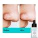 Buy Pure Niacinamide & Zinc Face Serum - Anti Blemish Pore Minimizer Acne Control & Oil Balancing Solution | Clear Acne Marks & Blemishes - Buy Online on GoSupps.com