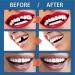 Fake Teeth for Missing Teeth - Temporary Tooth Repair Kit for Filling The Missing Broken Tooth and Gaps | Do It Yourself Thermal Fitting Beads for Vampire Dentures Moldable False Teeth - Buy Online on GoSupps.com