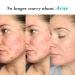 ZealSea Azelaic Acid 10% Facial Cream - Redness Relief, Rosacea & Acne Treatment, 1 oz - Buy Online on GoSupps.com
